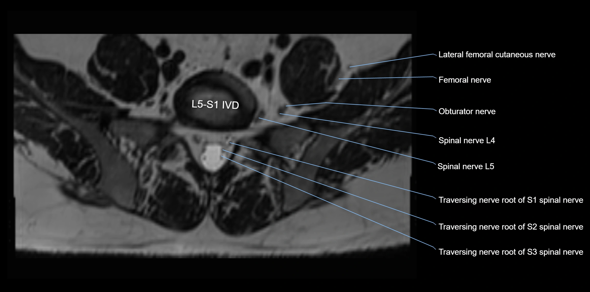 MR lumbosacral plexus axial cross sectional anatomy 3T  radiology  image-img-1008001-00064.webp